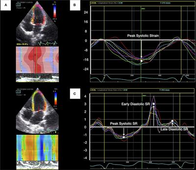 Subclinical Changes in Left Heart Structure and Function at Preschool Age in Very Low Birth Weight Preterm Infants